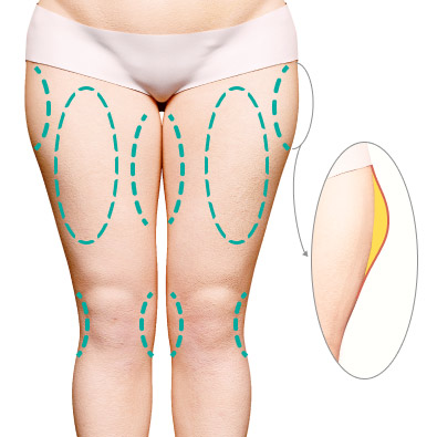 Обширные и локальные жировые отложения, нарушающие пропорции тела