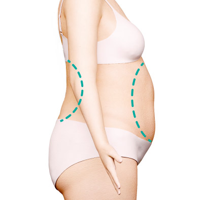 Значительные жировые отложения в области живота