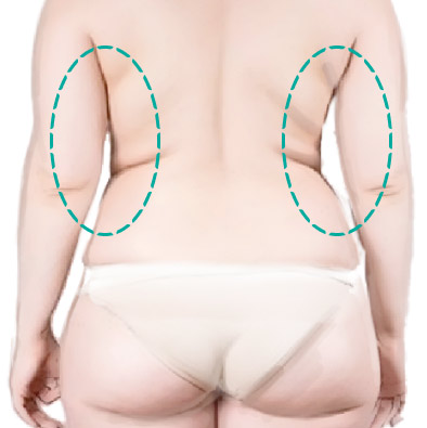 Гипертрофия жировых тканей спины и рук